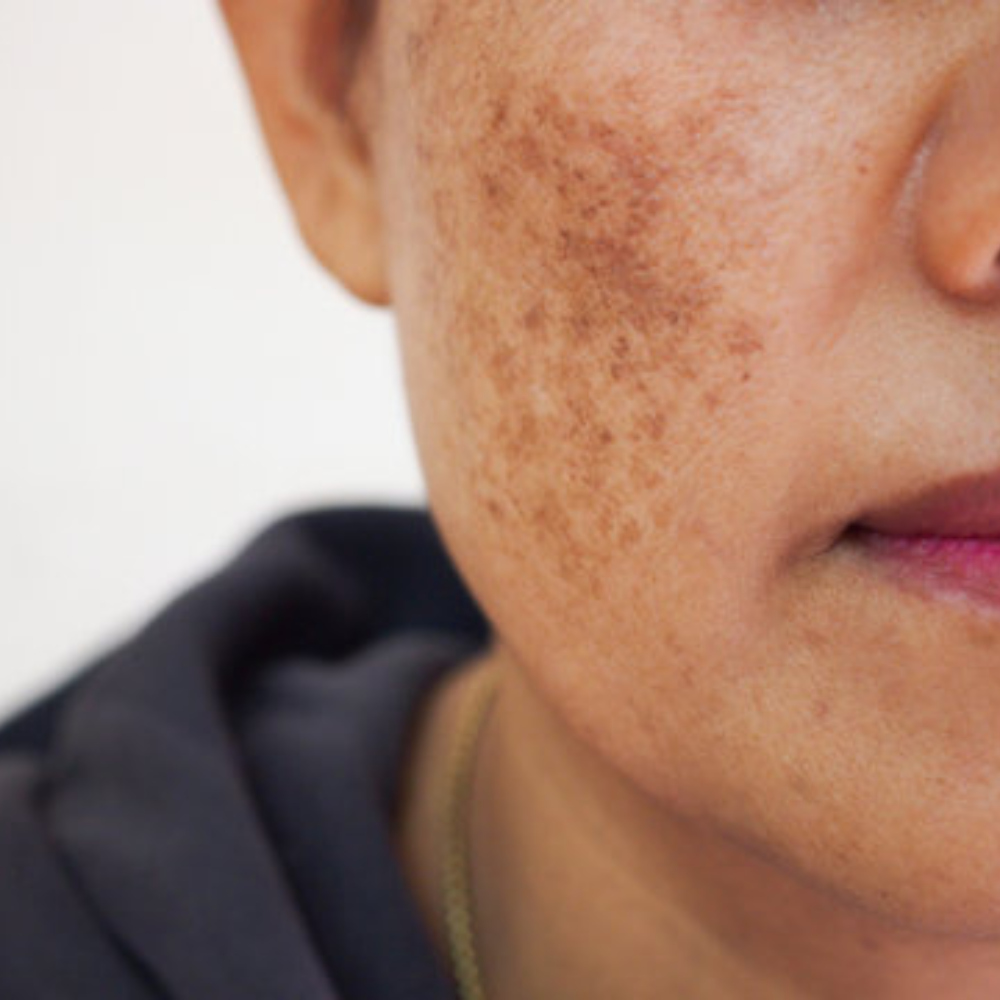 Melasma Dra. Monica