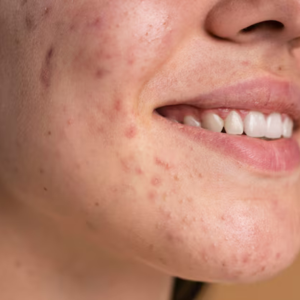 Acne Dra. Monica