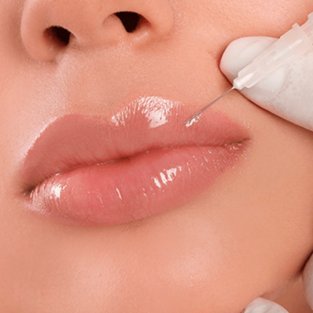 Preenchimento Labial Dra. Monica